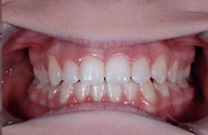 teeth after orthodontic treatment