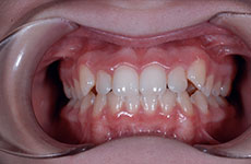 teeth before orthodontics