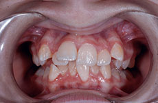 teeth before orthodontics