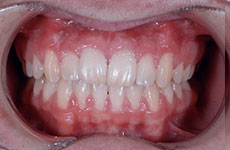 teeth after orthodontic treatment